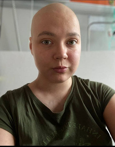 This is what Dasha looks like after a course of chemotherapy